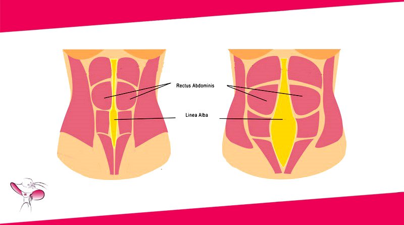 diastasi addominale